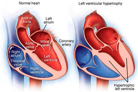 dilated lv means|mildly dilated left ventricle symptoms.